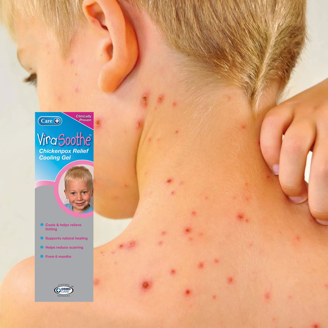 Virasoothe Chickenpox Relief Cooling Gel 75g Problem Skin Virasoothe Chickenpox Relief Cooling Gel 75g | Chickenpox Itch Relief
